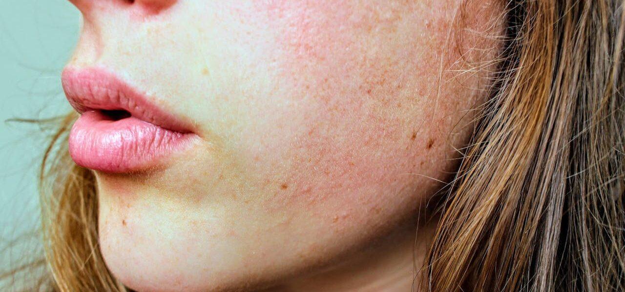The Ultimate Guide to Managing Rosacea