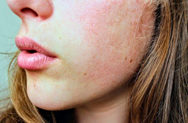 The Ultimate Guide to Managing Rosacea